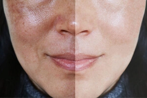 Scar/Wrinkle/ Acne/ Blemish Removal
