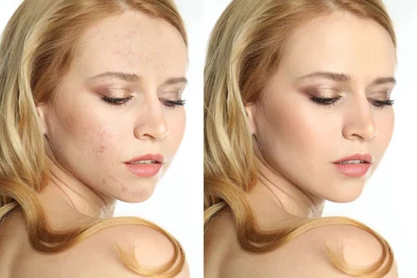 spots blemishes and moles