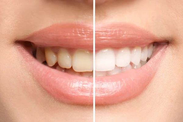 photo teeth color correction